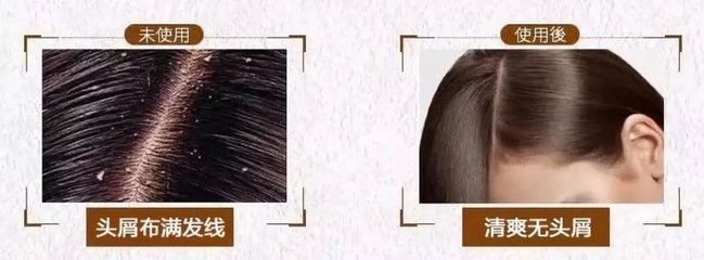 脫發、掉發、頭發稀少？用它洗洗，一次就離不開